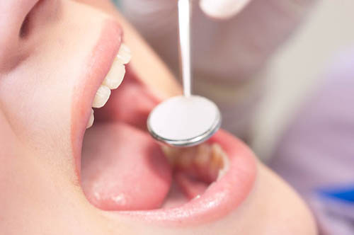 Cao răng gây mất thẩm mĩ và còn gây ra bệnh lý nghiêm trọng