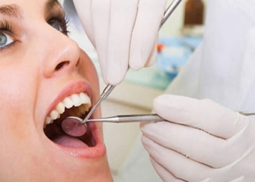 Cao răng nhiều có ảnh hưởng đến sức khỏe? Lấy cao răng như thế nào?