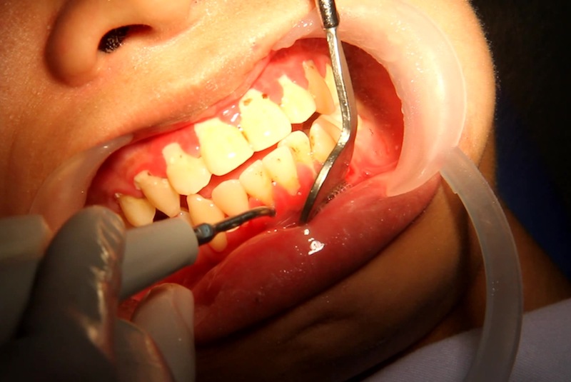 Cao răng là môi trường lý tưởng cho các vi khuẩn phát triển