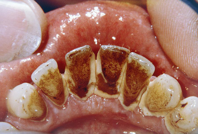 Cao răng gây ra những tác hại nào đối với sức khỏe răng miệng?
