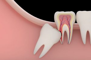 Đau răng hàm do nguyên nhân nào