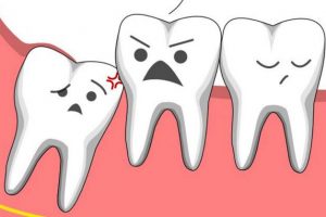 Đau răng khôn là tình trạng thường gặp