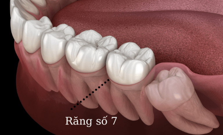 Sâu răng số 7 ảnh hưởng không nhỏ đến sức khỏe