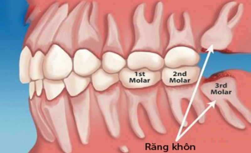 Răng số 8 còn được gọi là răng khôn